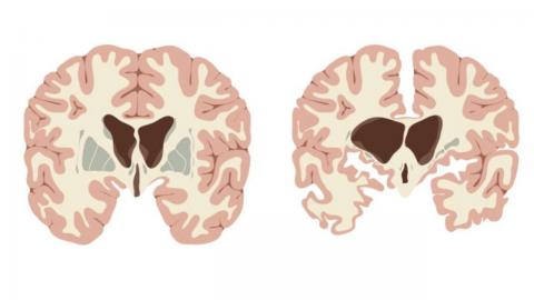 Huntington's Disease