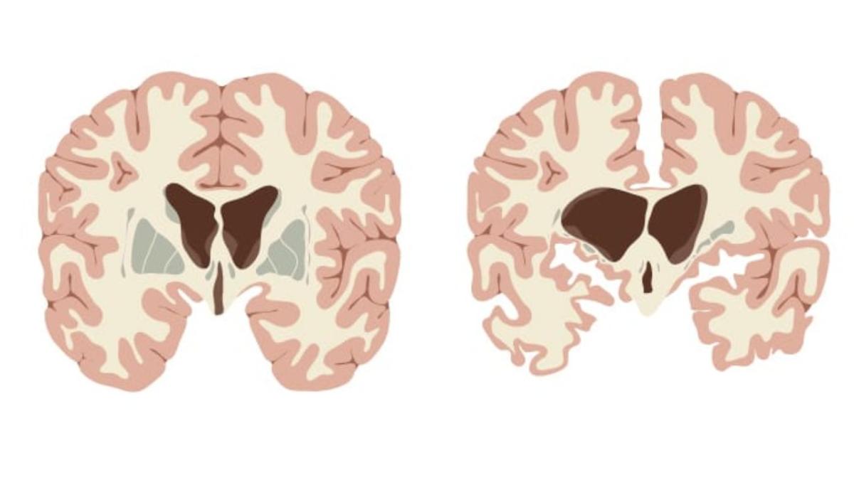 Huntington's Disease